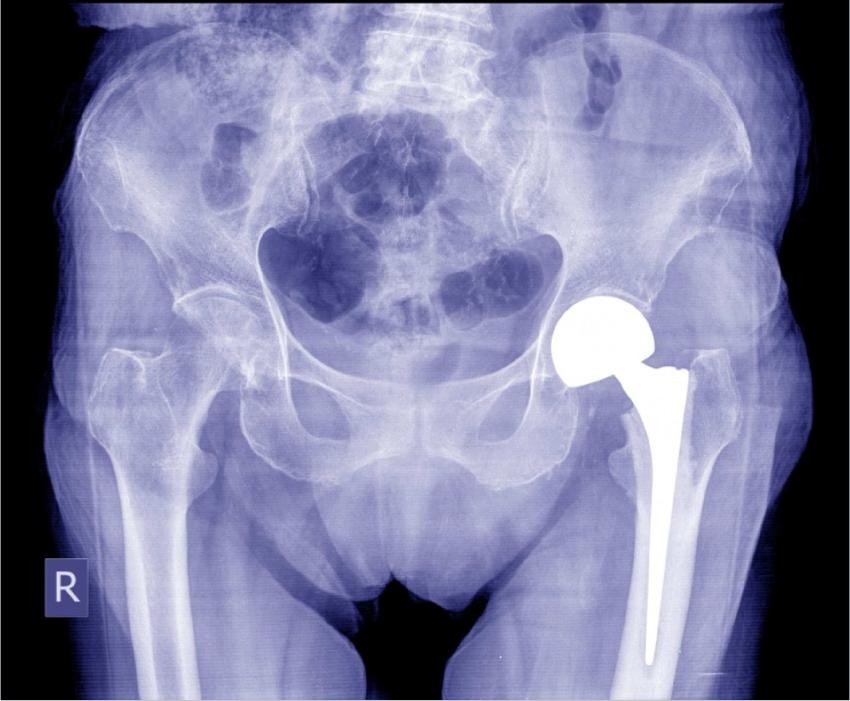 hip replacement x-ray hip pain